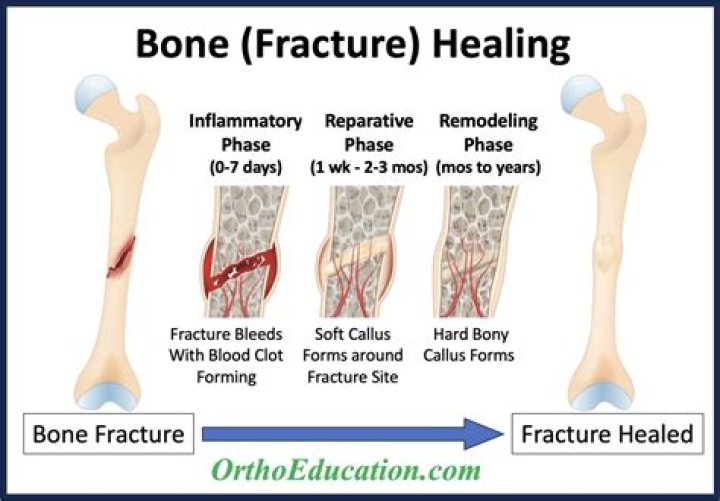 How do I know my fracture is healing?